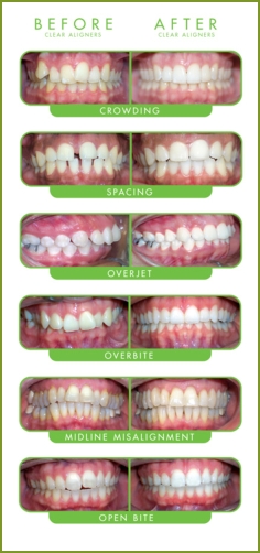 Invisalign Clear Braces Treatment for an Underbite in NYCDr. Jacquie